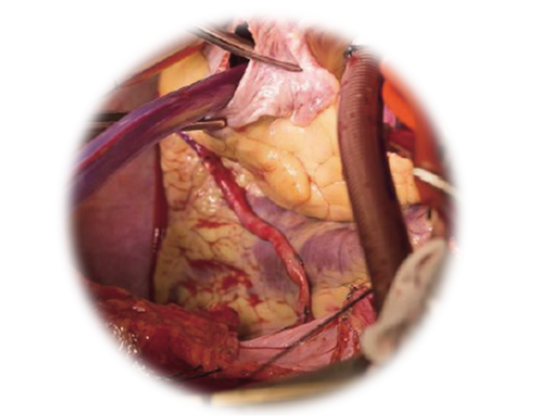 HyLED C Series LED Surgical Light with Multi-Patch Superposition Technology (MPST) for Open and Minimally Invasive Surgery