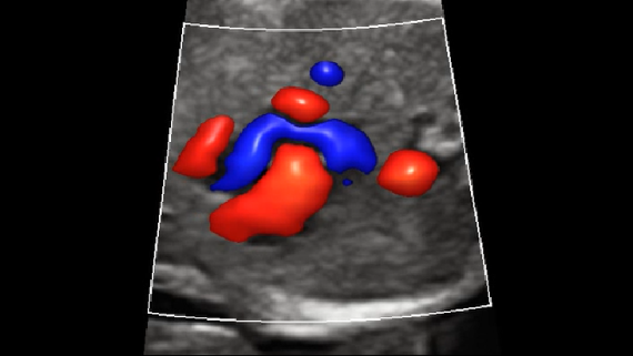 Mindray DC-70 Ultrasound System with X-Insight Technology for Precision Imaging