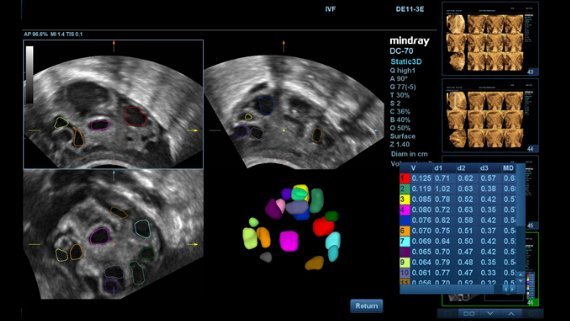 Mindray DC-70 Ultrasound System with X-Insight Technology for Precision Imaging