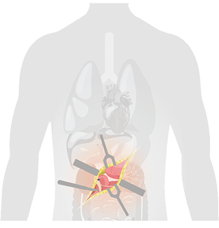 HyLED C Series LED Surgical Light with Multi-Patch Superposition Technology (MPST) for Open and Minimally Invasive Surgery