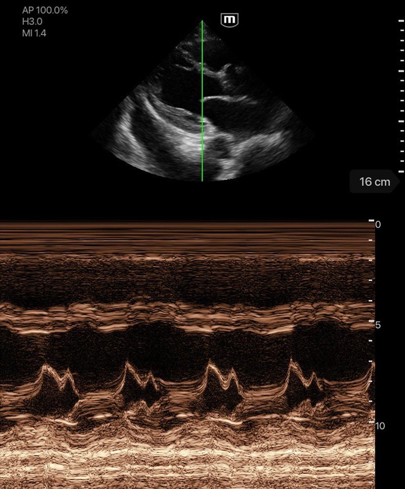 TE Air Wireless Handheld Ultrasound System - Mindray Portable POCUS Device for Emergency and Critical Care