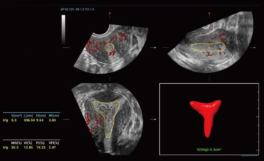 Nuewa R9 Platinum Edition Women's Healthcare Ultrasound System with Ultra-Micro Angiography Technology