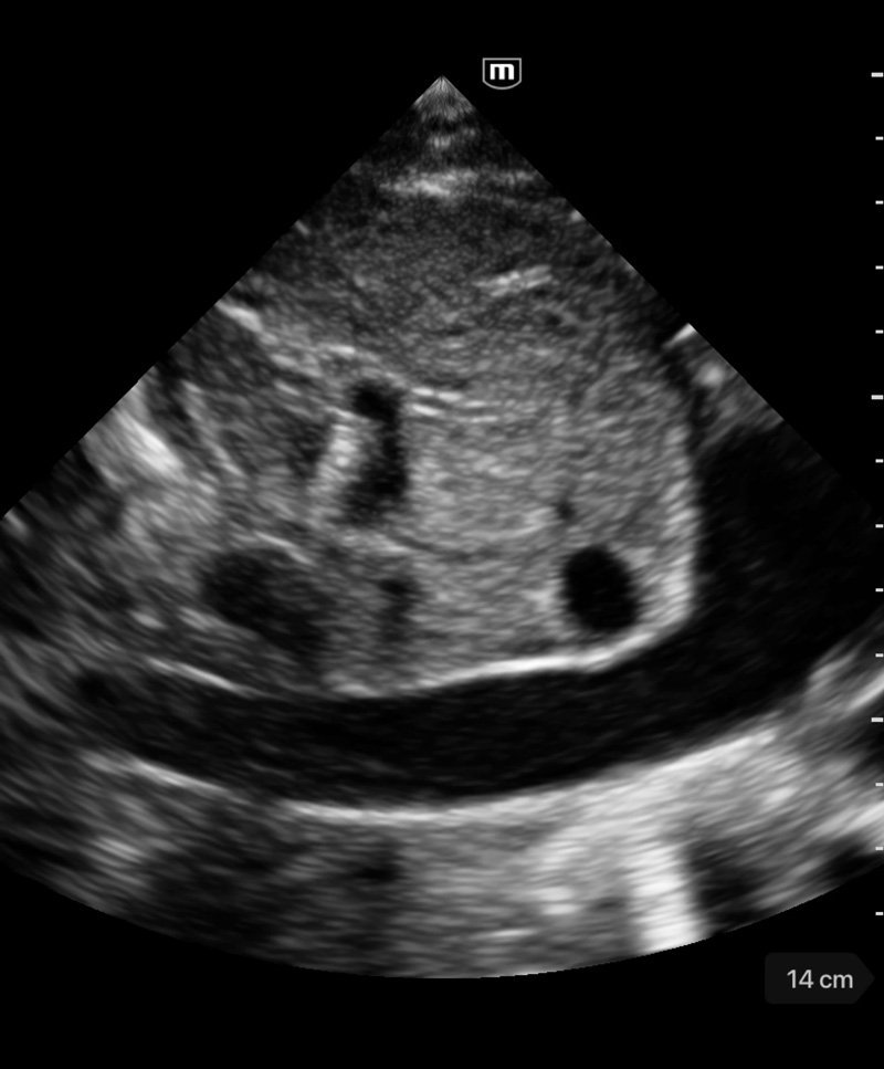 TE Air Wireless Handheld Ultrasound System - Mindray Portable POCUS Device for Emergency and Critical Care