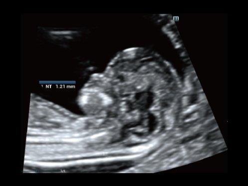 Mindray DC-80A Diagnostic Ultrasound System with X-Insight Technology