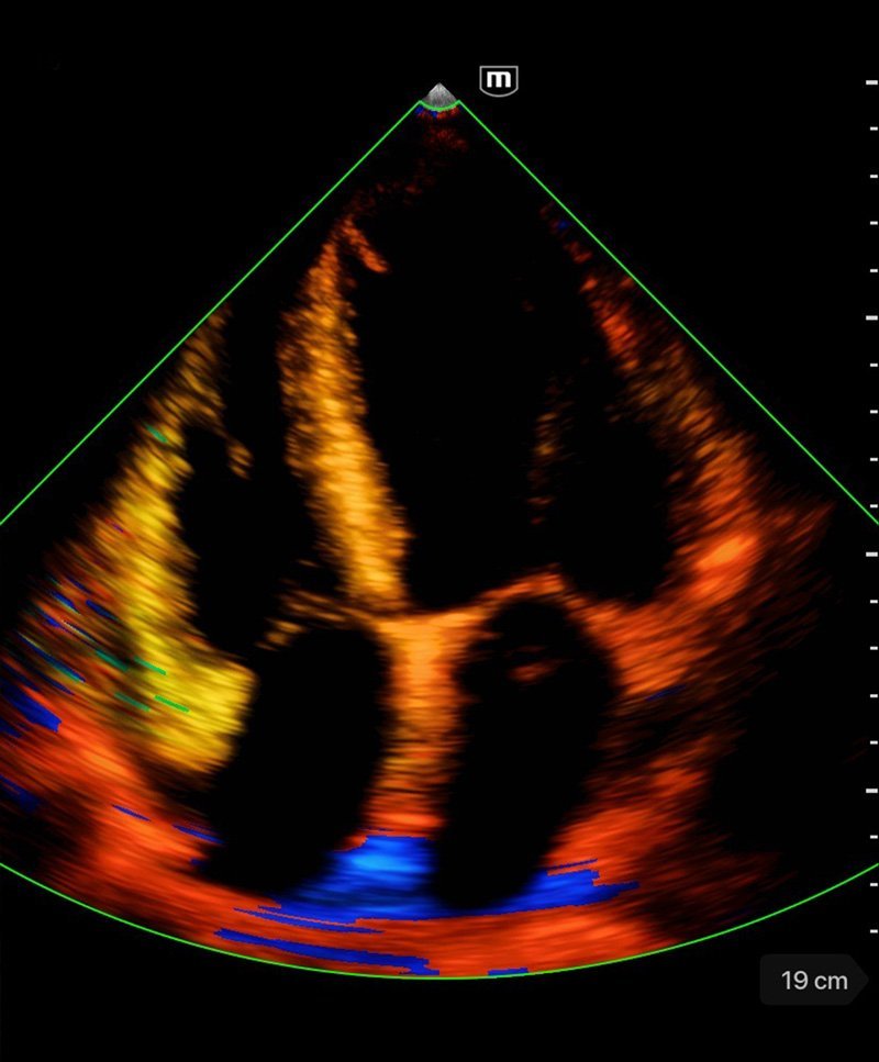 TE Air Wireless Handheld Ultrasound System - Mindray Portable POCUS Device for Emergency and Critical Care