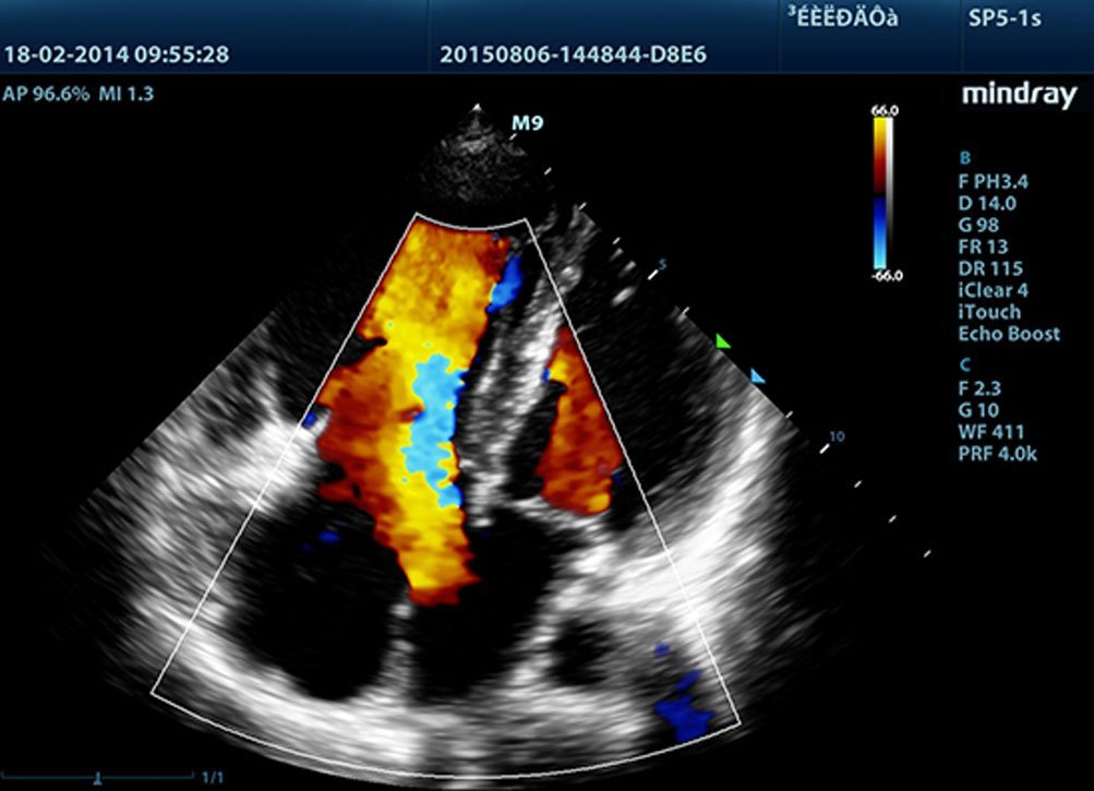 Mindray M9 Portable Ultrasound System - Advanced Imaging and Diagnostic Solutions