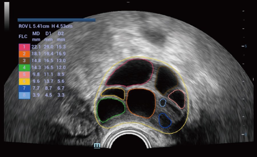 Nuewa R9 Platinum Edition Women's Healthcare Ultrasound System with Ultra-Micro Angiography Technology