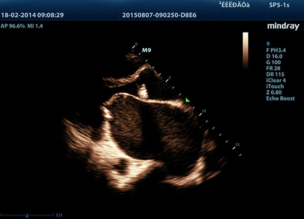 Mindray M9 Portable Ultrasound System - Advanced Imaging and Diagnostic Solutions