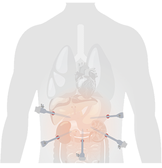 HyLED C Series LED Surgical Light with Multi-Patch Superposition Technology (MPST) for Open and Minimally Invasive Surgery