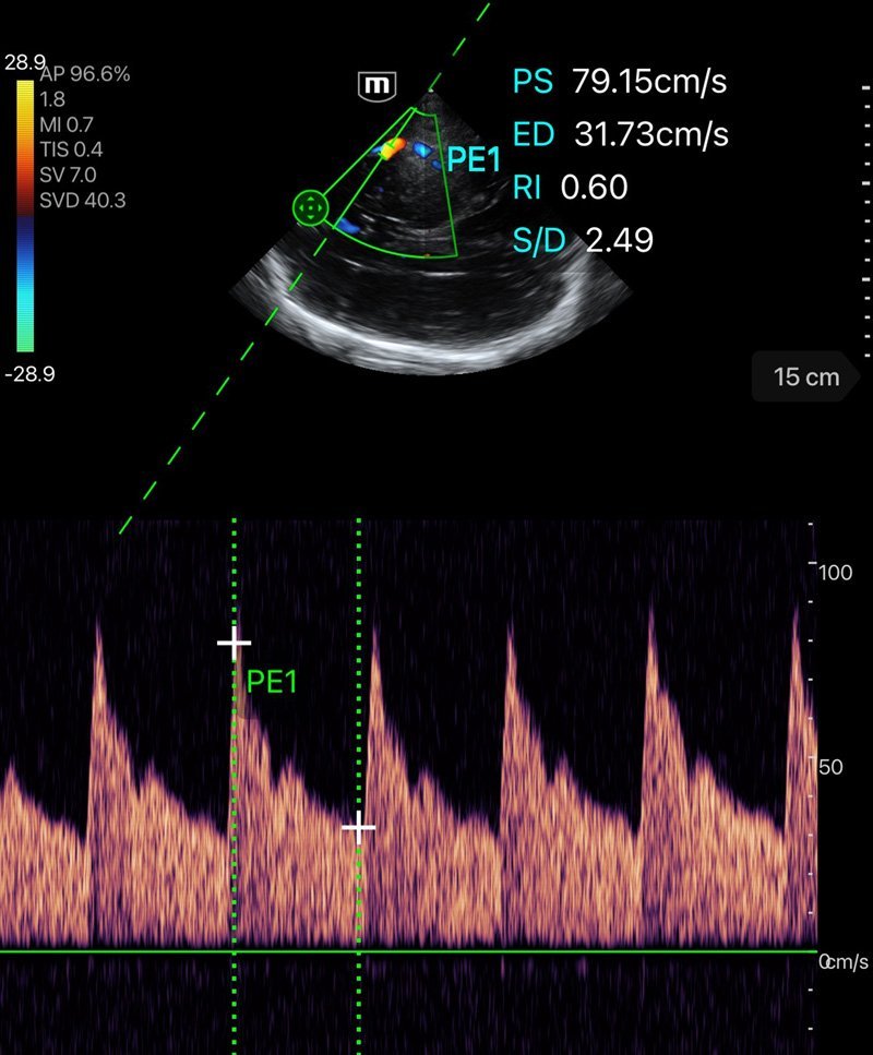 TE Air Wireless Handheld Ultrasound System - Mindray Portable POCUS Device for Emergency and Critical Care