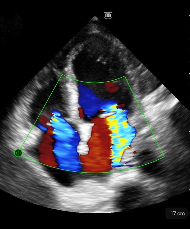 TE Air Wireless Handheld Ultrasound System - Mindray Portable POCUS Device for Emergency and Critical Care
