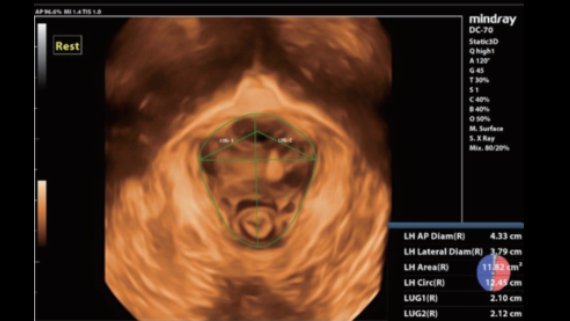 Mindray DC-70 Ultrasound System with X-Insight Technology for Precision Imaging