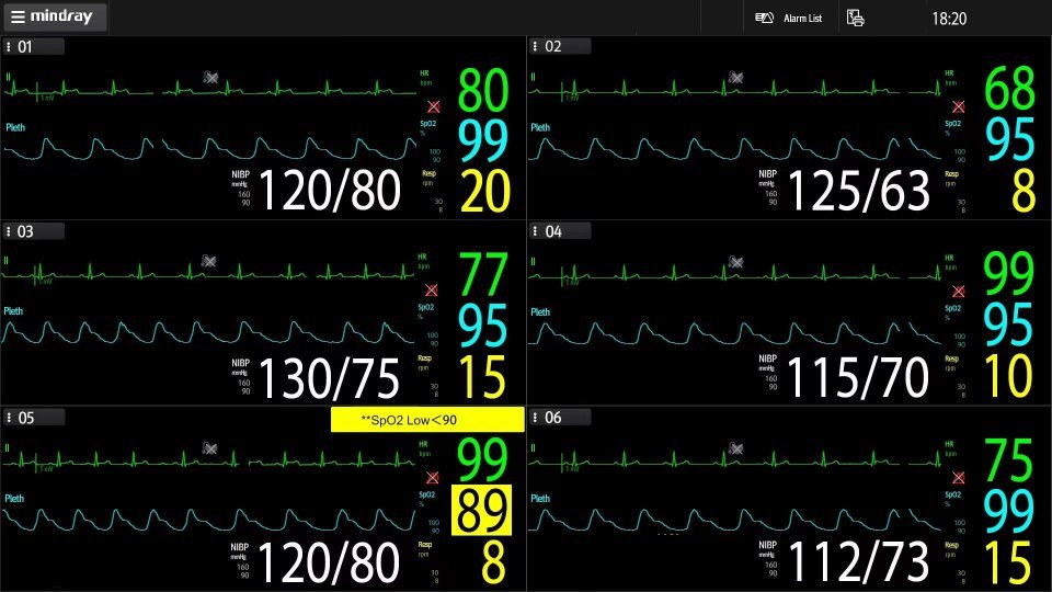 Anesthesia System A5 Model - Integrated Intravenous-Inhalational Solution with Enhanced Safety and Efficiency