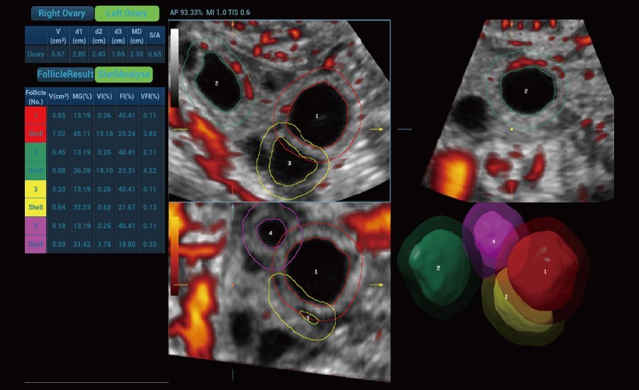 Nuewa R9 Platinum Edition Women's Healthcare Ultrasound System with Ultra-Micro Angiography Technology