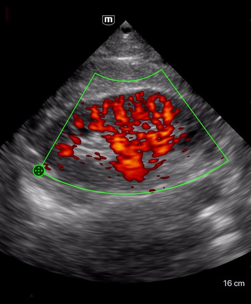 TE Air Wireless Handheld Ultrasound System - Mindray Portable POCUS Device for Emergency and Critical Care