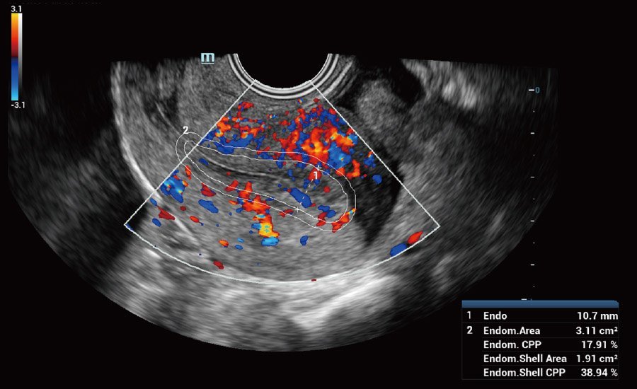 Nuewa R9 Platinum Edition Women's Healthcare Ultrasound System with Ultra-Micro Angiography Technology