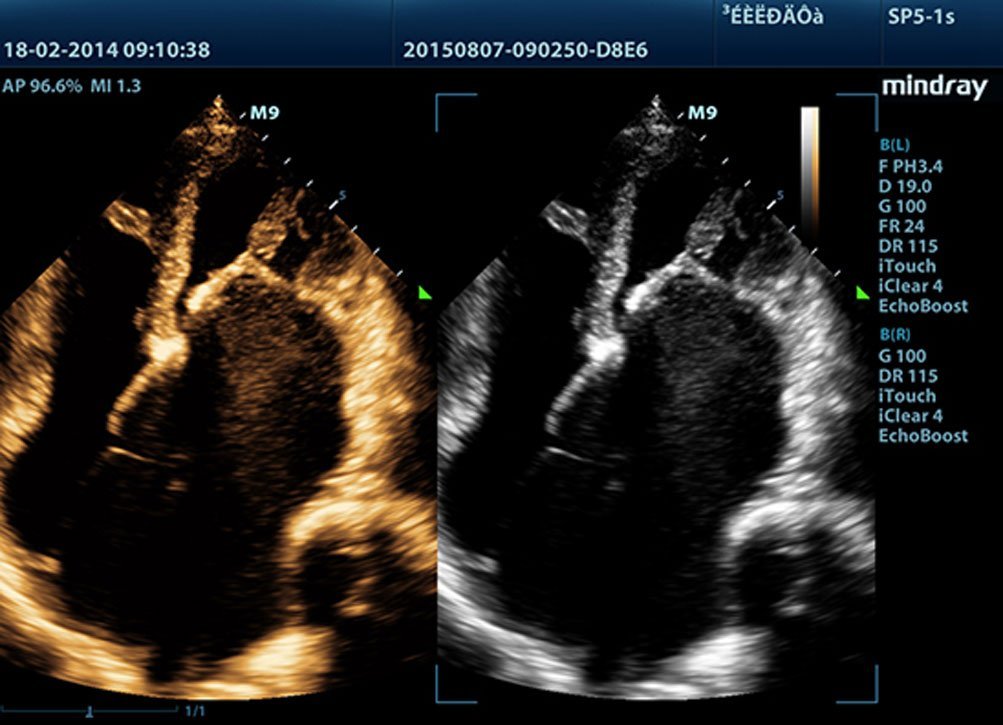 Mindray M9 Portable Ultrasound System - Advanced Imaging and Diagnostic Solutions