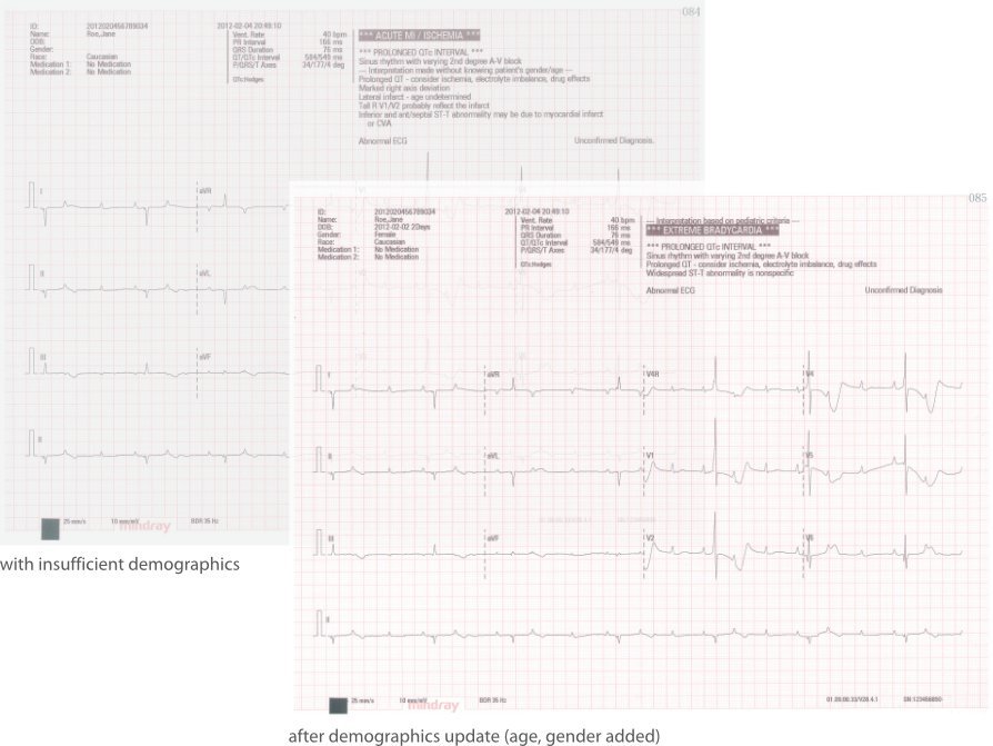BeneHeart R12 12-Channel Electrocardiograph ECG Machine