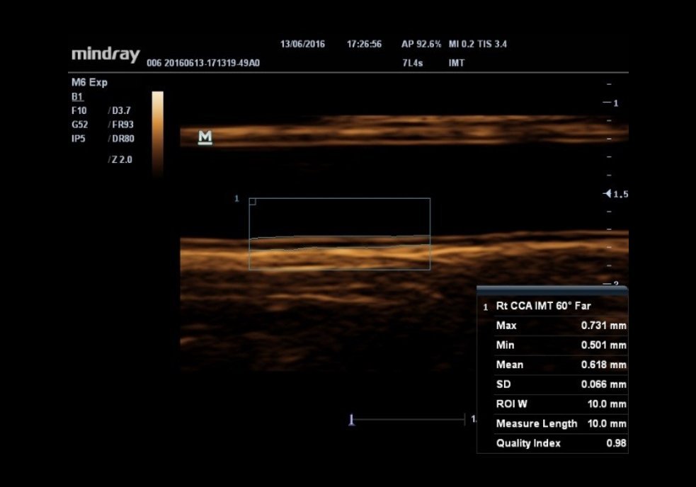Mindray M6 Ultrasound System - Compact, Portable, and High-Performance Diagnostic Tool