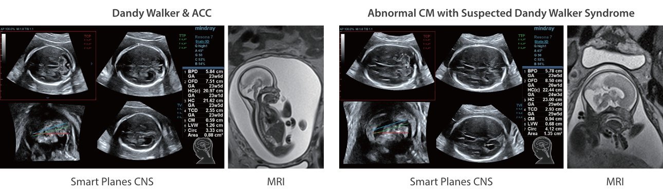 Mindray Resona 7 Premium Ultrasound System with ZONE Sonography Technology and Advanced Imaging Features