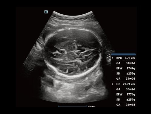 Mindray DC-80A Diagnostic Ultrasound System with X-Insight Technology