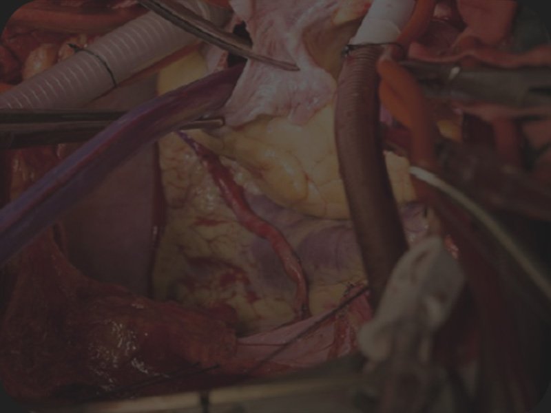 HyLED C Series LED Surgical Light with Multi-Patch Superposition Technology (MPST) for Open and Minimally Invasive Surgery