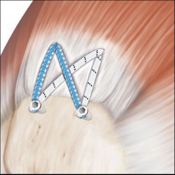 ORTHOPROMED FIBER TAPE SUTURE